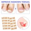 100PCS Ingrown Toenail Correction Stickers -Adhesive Foot Patches for Paronychia Treatment and Pedicure Care view 4