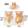 GoiterX - Goiters & Nodules. Potent Natural Remedy for Treatment of Goiter and Nodule Flare-Ups by Maintaining The Natural Balance of The Thyroid System. view 4