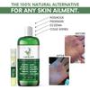 All Natural Eczema Treatment- Psoriasis Treatment - an All-in-One Solution for Acne, Dermatitis, Rosacea, Cold Sores, Pet Rashes, Bug Bites, and Poison Ivy - Anti-Itch Spray for Itchy Skin Relief view 2