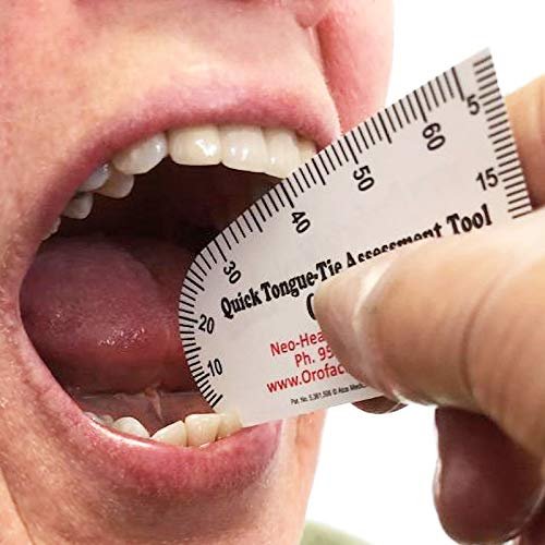 Quick Tongue-Tie Assessment (50)