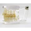 Model,Transparent Standard Model Implant Model for Teaching Adult,Transparent view 2