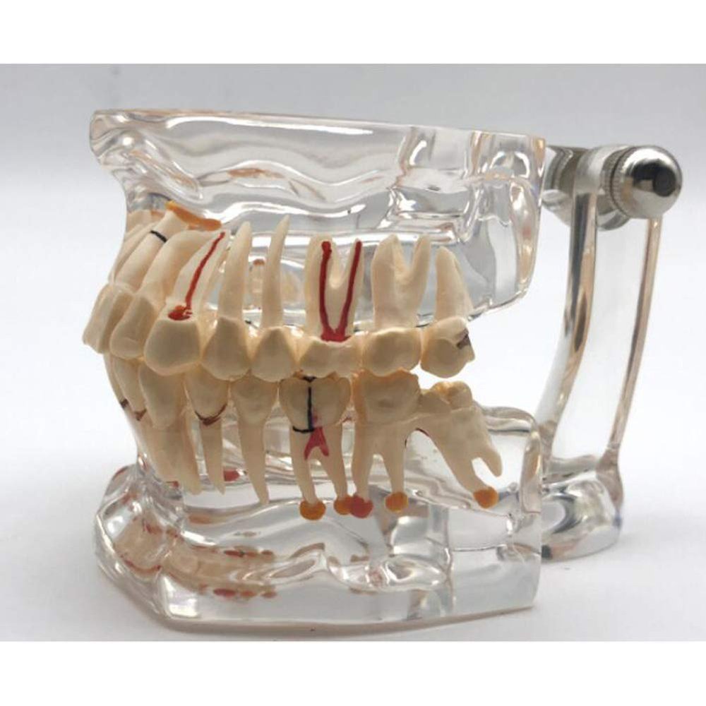 Dental Teeth Model,32 pcs Teeth Implant Demonstration Model Unremovable for Dental Student Education