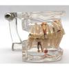 Dental Teeth Model,32 pcs Teeth Implant Demonstration Model Unremovable for Dental Student Education view 2
